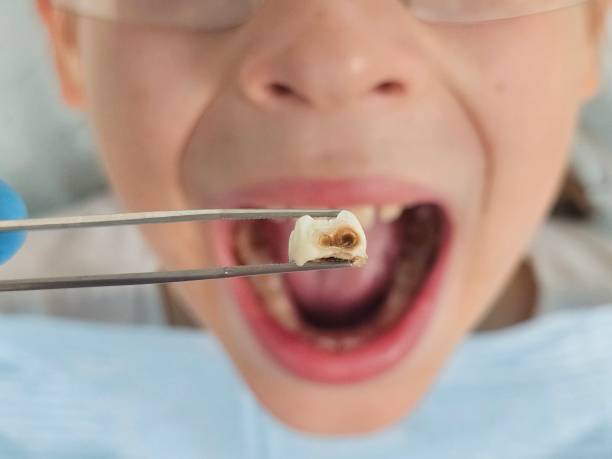 Best Root Canal Emergency Dentist  in Warrensburg, IL